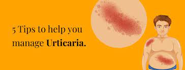 how to cure urticaria permanently