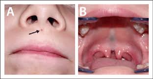 midline upper lip sinus of the philtrum