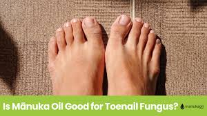 is mānuka oil good for toenail fungus