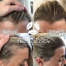 hair loss treatment news evolution