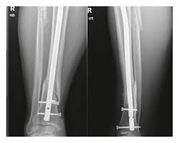 intramedullary nails on spiral fracture