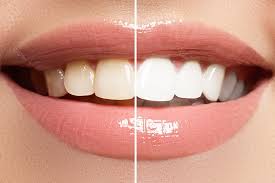 5 common teeth whitening mistakes