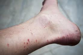 The condition improves as the patient grows older; Dengue Fever Symptoms Treatment And Prevention