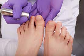 laser therapy for fungal toenails