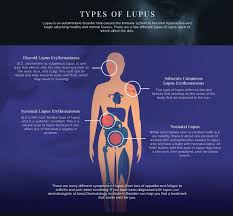 Find out more about lupus: Lupus Treatment Dermatology Services In Boulder Azeal Dermatology Institute