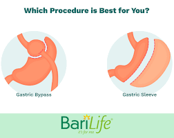 gastric sleeve vs gastric byp what
