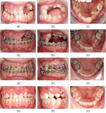 orthognathic surgery in cleft lip and