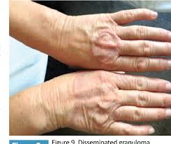Widespread granuloma annulare more rarely, you can develop a widespread rash, known as generalised or disseminated granuloma annulare. Disseminated Granuloma Annulare 3 Clinical Cases Semantic Scholar