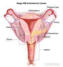 Healthians blog > disease > endometriosis: Definition Of Stage Iii Endometrial Cancer Nci Dictionary Of Cancer Terms National Cancer Institute