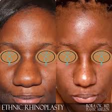 Nose job for wide nose bridge. Ethnic Rhinoplasty African American Asian Nose Job Before After Gallery