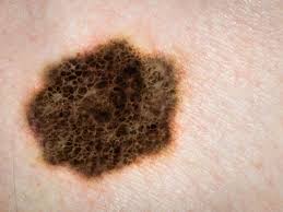 home remedy for skin cancer may cause