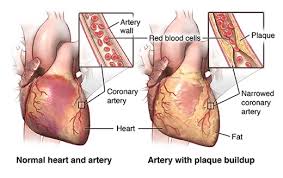 Large holes can cause symptoms in later childhood or adulthood due to the increased blood flow through the right side of the heart. Coronary Artery Bypass Graft Surgery Johns Hopkins Medicine