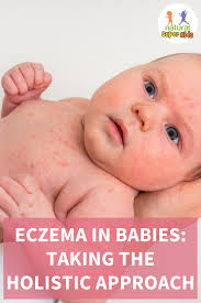 eczema in es taking the holistic