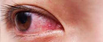 read insights about red bloodshot eyes