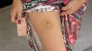 bullet wound takes woman by surprise