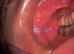 leukoplakia symptoms causes