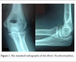 Psoriatic Arthritis Mutilans  Clinical and Radiographic Criteria     PNG