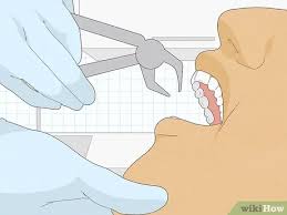 Check spelling or type a new query. 7 Ways To Fix An Overbite Wikihow
