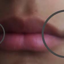 dark lip corners and hydroquinone