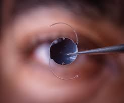 lasik and cataract surgery