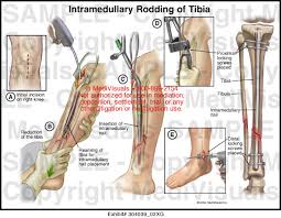 intramedullary rodding of tibia cal