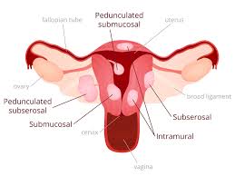 uterine fibroids omnicare