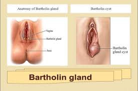 What is a bartholin cyst? Bartholin S Cyst Health Navigator Nz