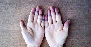 peripheral cyanosis blue hands and