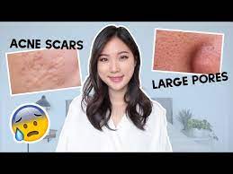how to prevent acne scars how to