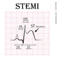 Ecg Of St Elevation Myocardial Infarction Stemi Stock