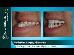 Instead, jaw surgery (or orthognathic surgery) may be recommended. Underbite Correction Without Surgery No Braces No Aligners