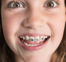 Get the look you long forby making a pair yourself. Dentists Warn Children Not To Make Their Own Braces