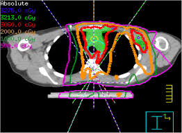 axial ct treatment planning scan shows