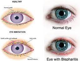 blepharitis golden eye optometry