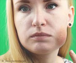 Facial Swelling Symptom Evaluation