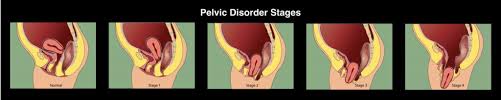 are pelvic floor disorders a normal
