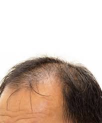 does minoxidil work on frontal baldness
