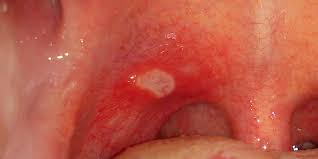 why do i have a mouth ulcer guides