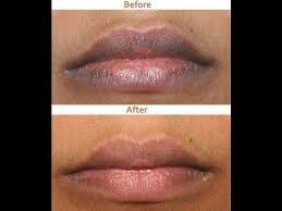 what causes dark lips