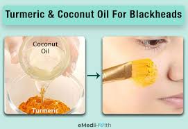 how to get rid of blackheads at home