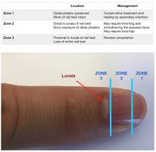 zones of fingertip injuries zone 1