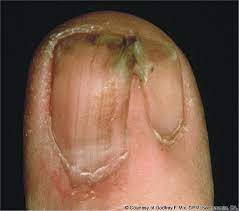 chapter 24 nail diseases and disorders