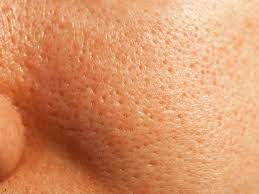 how to get rid of open pores 10