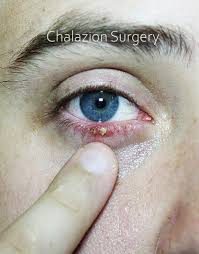 chalazion surgery in iran procedure