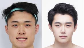 south korean men having plastic surgery