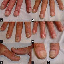 treatment of severe nail psoriasis with