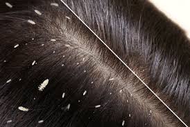 lice hair images browse 4 605 stock