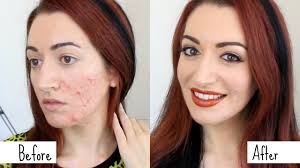 cover acne makeup transformation