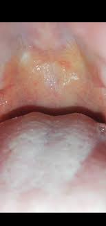 I thought everyone had this! Bump On Soft Palate Dentistry