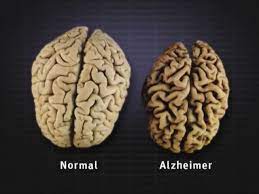 video normal brain vs alzheimer s